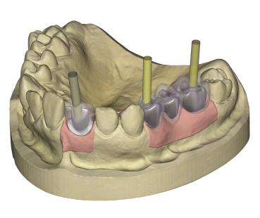 Implant Module Implant Module