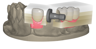 In-Cad Nesting Module Upgrade In-Cad Nesting Module Upgrade