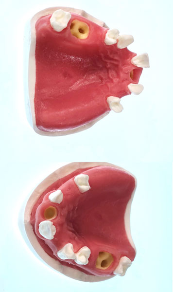 Oberkiefer mit Gingiva